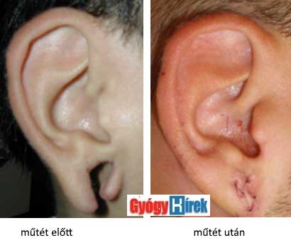 fül plasztikai műtéte