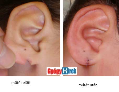 fül plasztika