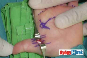 pattanó ujj műtét ára