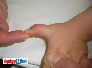a kis ujj kezelése