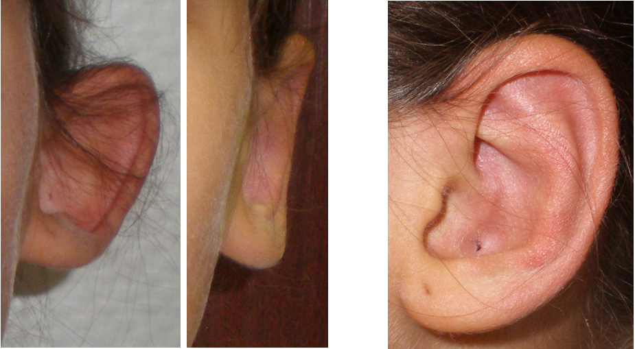 Fülplasztika előtt és után
