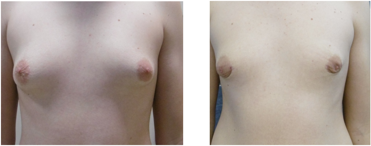 Mellkisebbites (gynecomastia ) műtét előtt és után. Fotó: Dr. Novoth - dr. Végh