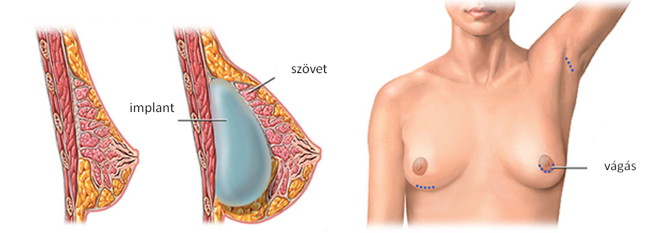 mell implantátum csere