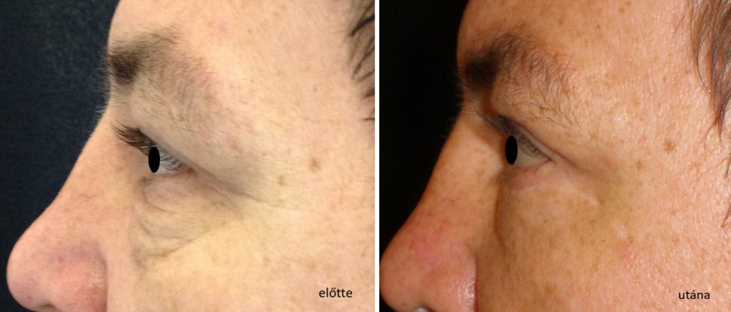 Alsó szemhéjplasztika: előtte és utána (galéria)