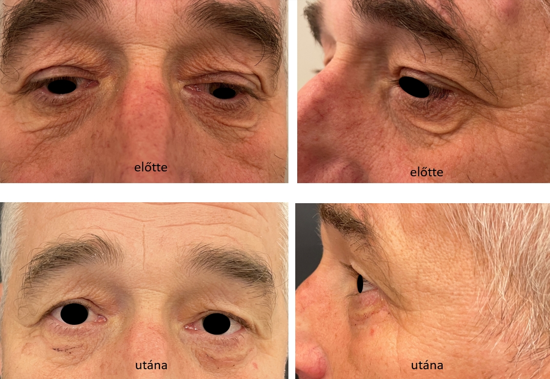 Alsó szemhéj bőrredő megszűntetése - előtte és utána. Fotó: dr. Novoth.
