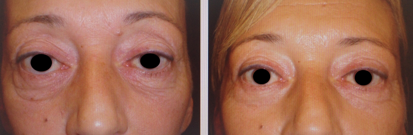 Szemhéjplasztika utáni alsó bőrredők korrigálása - műtét előtt és után. Fotó: dr. Novoth.