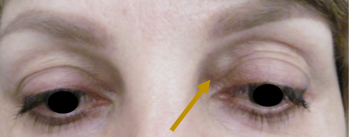 Csomószerű zsírszaporulat a felső szemhéj alatt: szemhéjplasztikával ez is megoldható. 