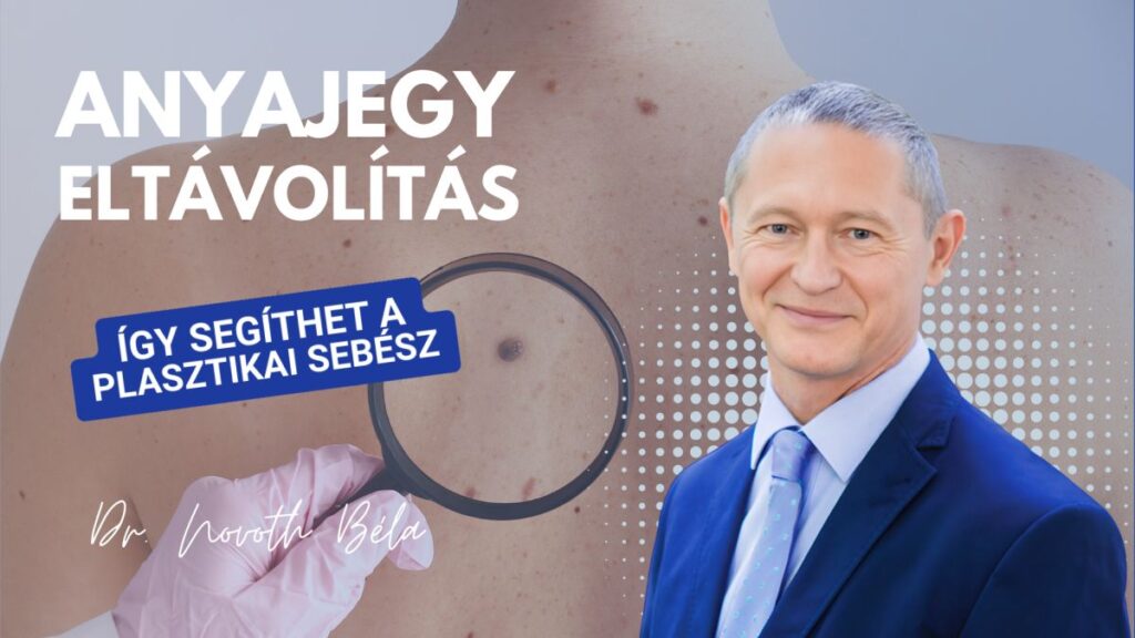 Anyajegy eltávolítás: mikor indokolt, és hogyan történik?